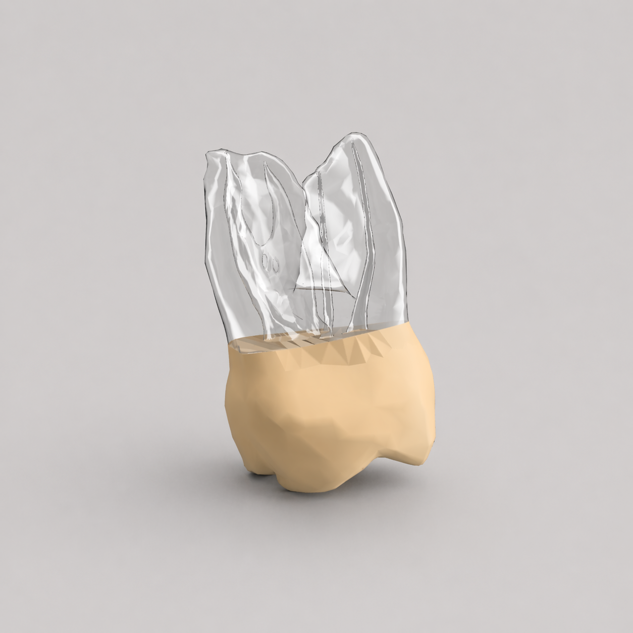 Tooth #14B (Upper Left First Molar)