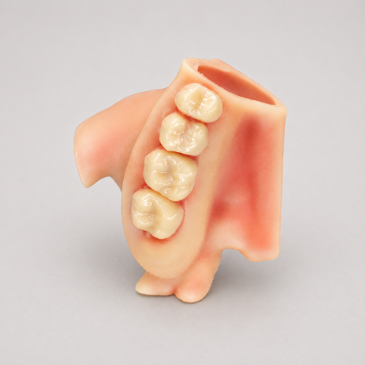 Maxillary Quadrant Extraction w/ 3rd Molar (CBCT Based)
