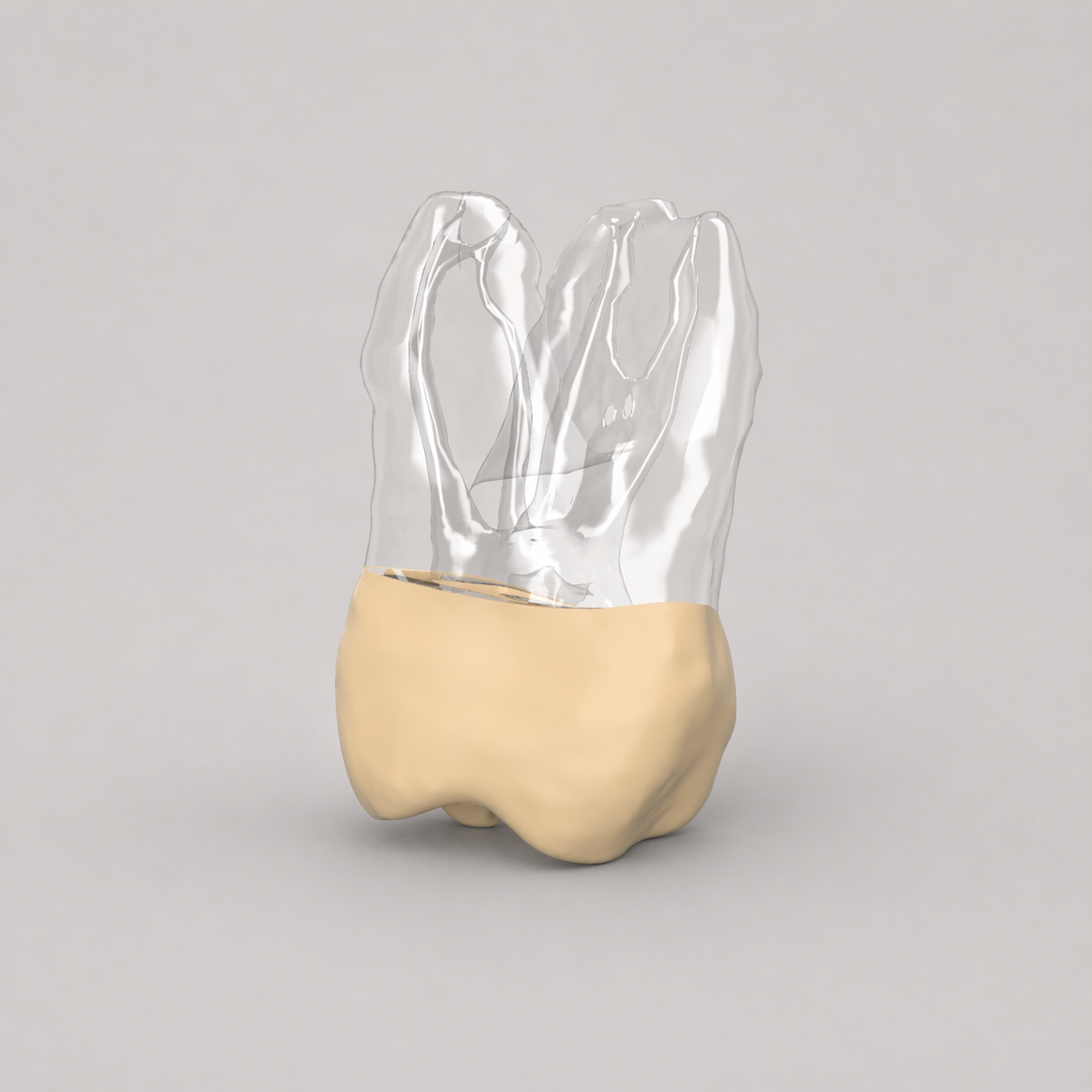 Tooth 3x With Carie (Upper Right First Molar)