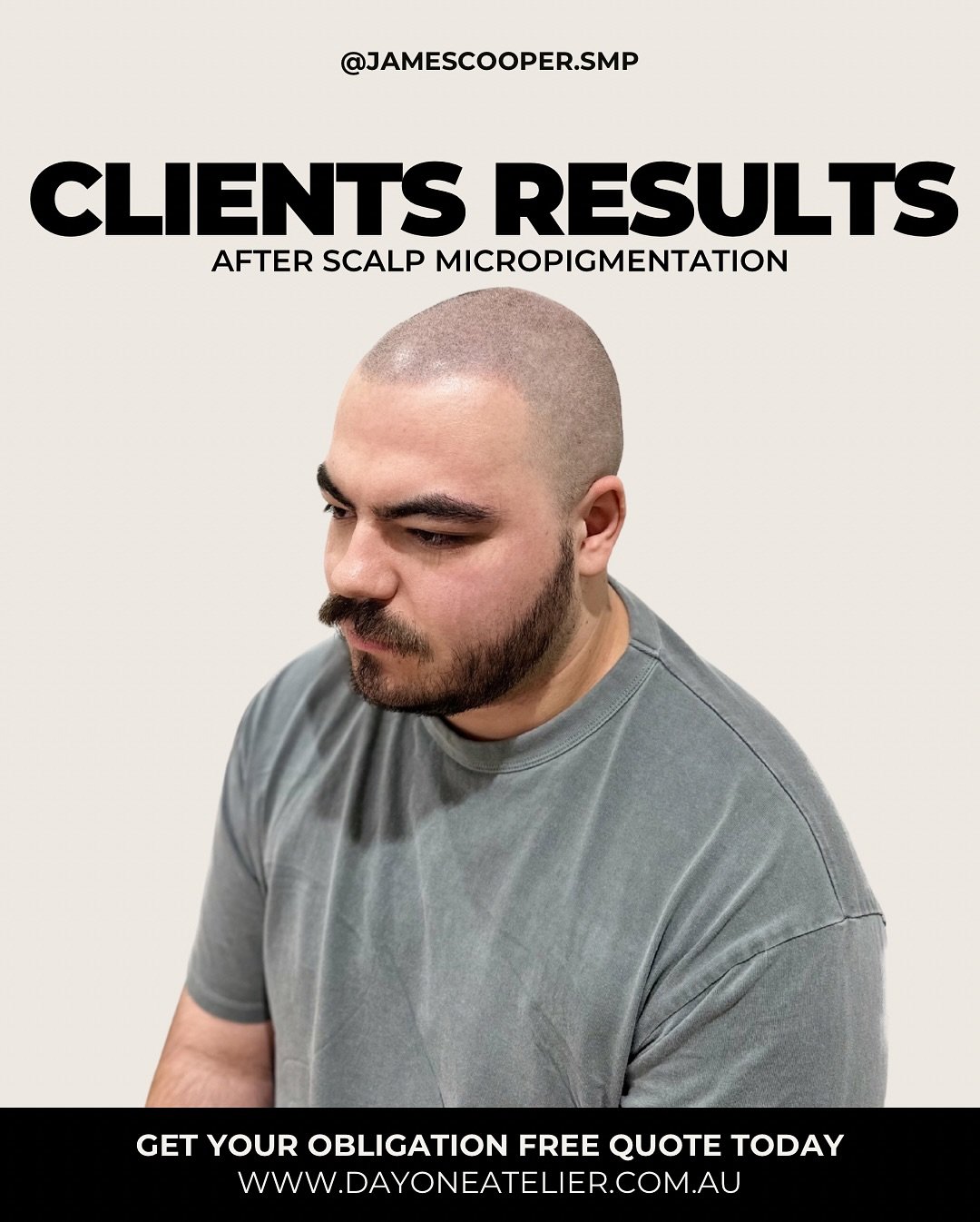 This client had 3 sessions of Scalp Micropigmentation &mdash; and the difference is night and day.
We recreated a soft, natural-looking hairline that blends seamlessly and suits his features.

Swipe ➡️ to see the before photo and how far we&rsquo;ve 