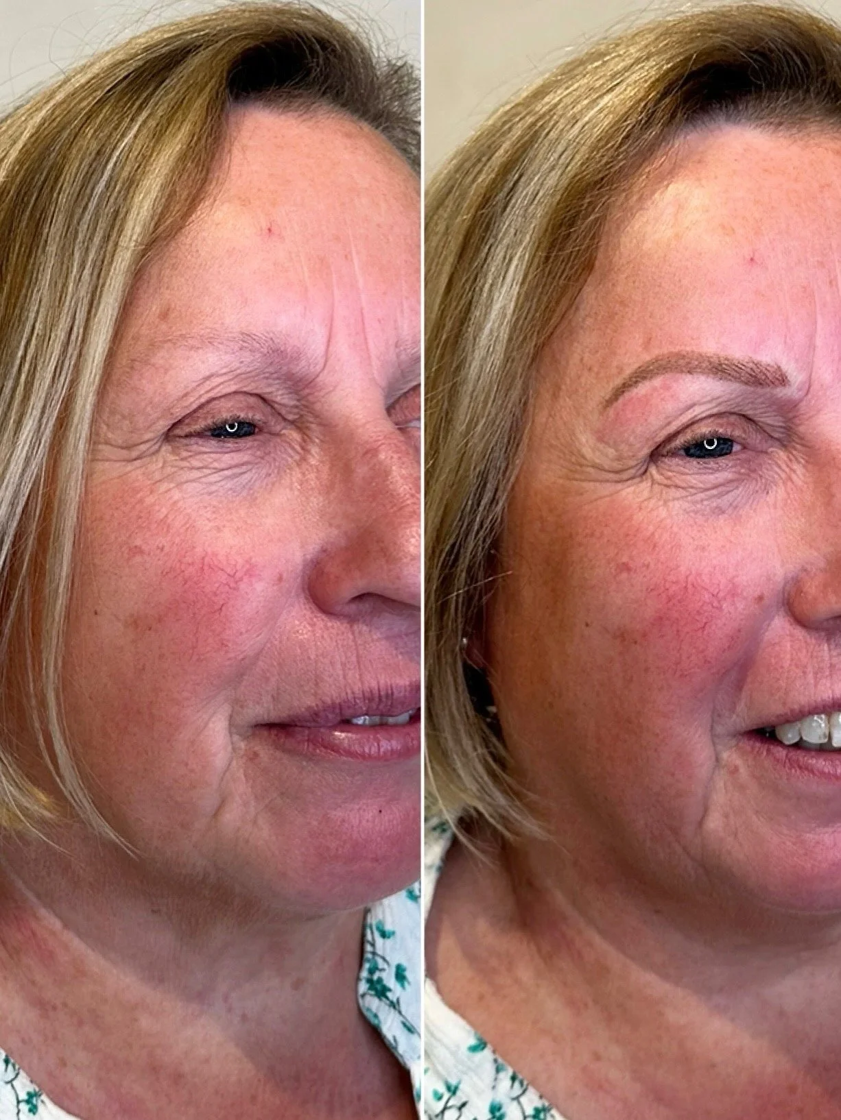 Side-by-side comparison of a woman's face before and after cosmetic treatment, showing improved skin texture, reduced wrinkles, and enhanced eyebrows.