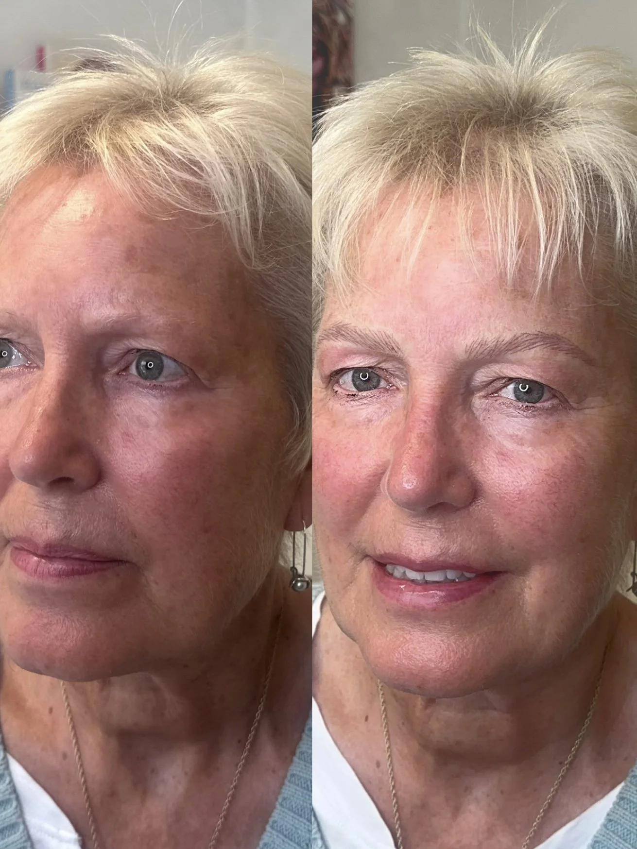 Comparison of a woman's face before and after skincare or cosmetic treatment, showing improved skin texture and appearance.