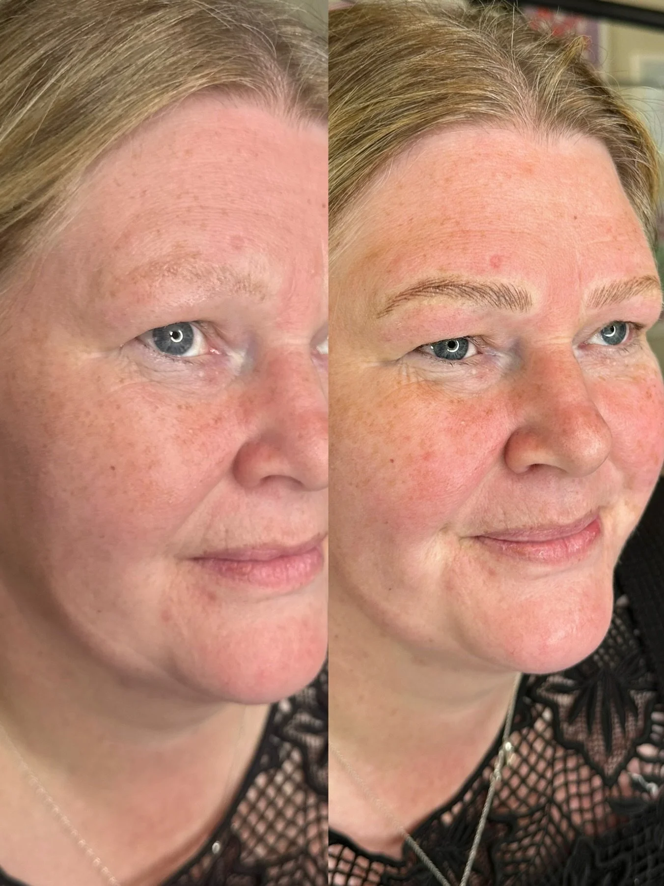 Side-by-side comparison of a woman's face, showing before and after skin treatment, with improved skin texture and reduced redness.