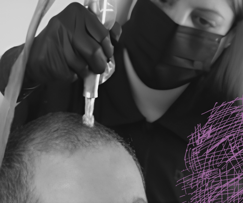 Microneedling : Hair growth Therapy treatment