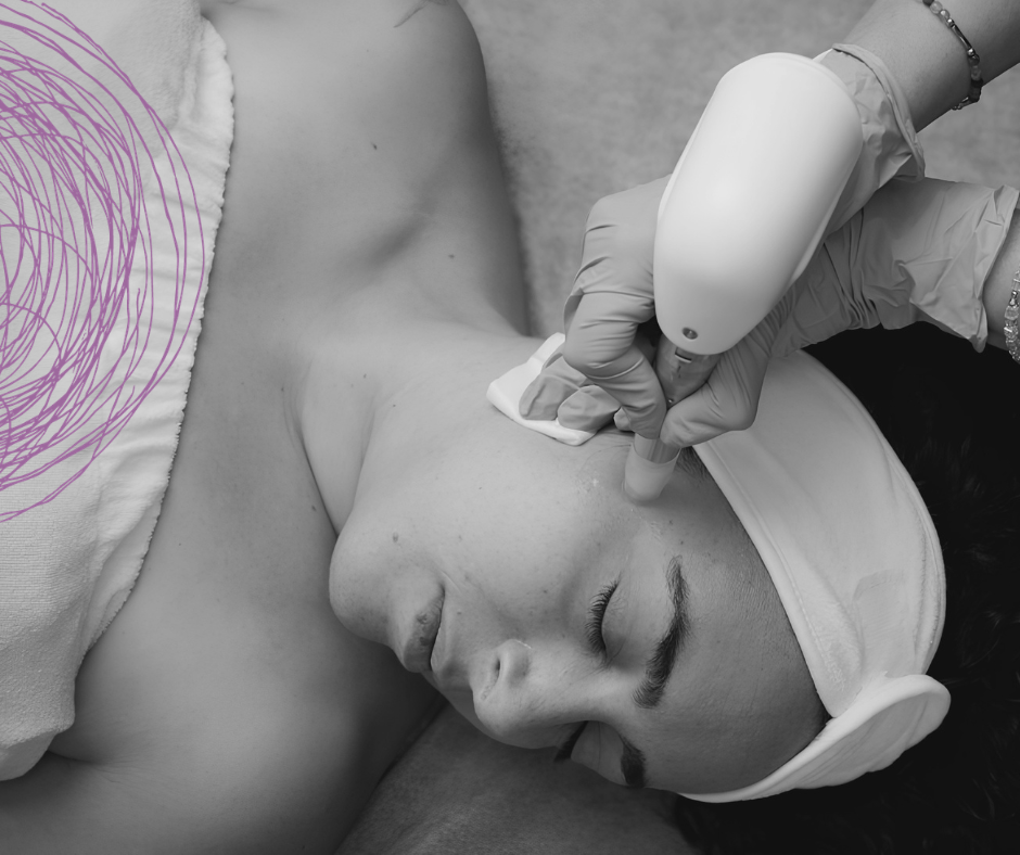 Microneedling : Pigment Correction