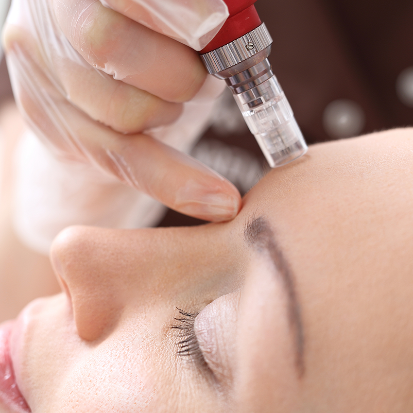 Microneedling : Hair growth Therapy treatment — Sincerely, Skin: Spa and  Laser Boutique Serving Halifax Since 2010 | Facials, Massage, Reflexology,  Microneedling, Electrolysis & More | Laser Hair Removal, Dermaroller,  Oxygeneo Facials |