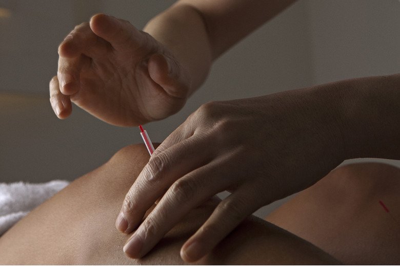 Acupuncture 2-cropped_0.jpg
