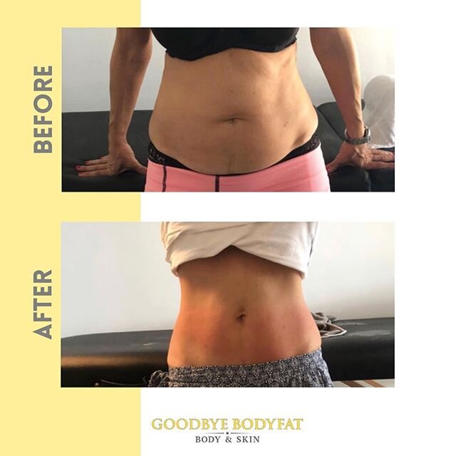 Results so impressive you would think it was an invasive liposuction procedure! ⁣
⁣
For a limited time only, we&rsquo;re offering 50% off our treatment packages so that you can see results like these✨ ⁣
⁣
Link in bio⁣
⁣
⁣
⁣
⁣
⁣
⁣
⁣
⁣
⁣
#weightloss #n