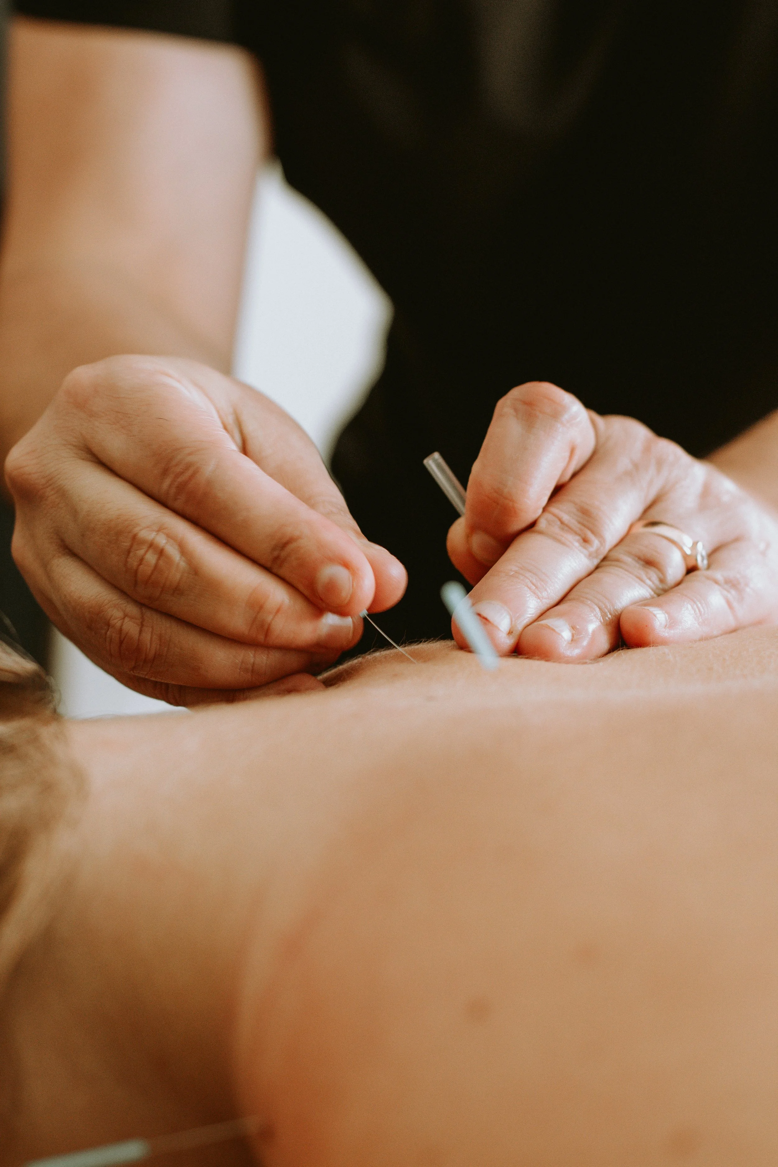 Your First Acupuncture Visit at Rooted Method: What to Expect