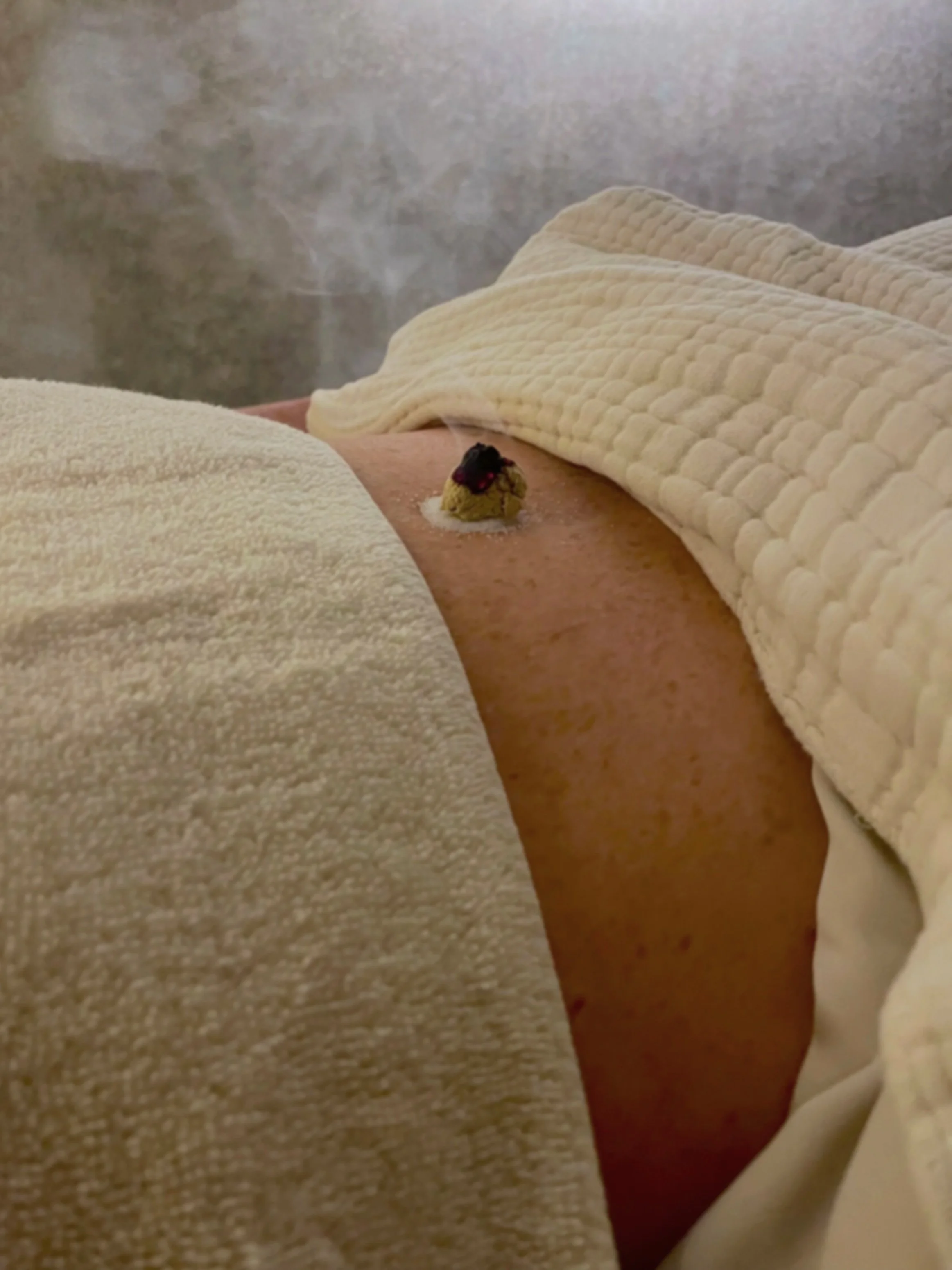 Moxibustion at Rooted Method