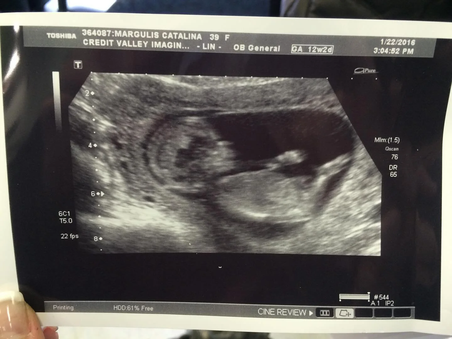 2016 might be my favourite year.

In 2016 I found out I was having a daughter. 😍

I made the announcement by posting a photo of me 5 months pregnant at physiotherapy with my compression socks and the caption &ldquo;Does this outfit make me look fat?