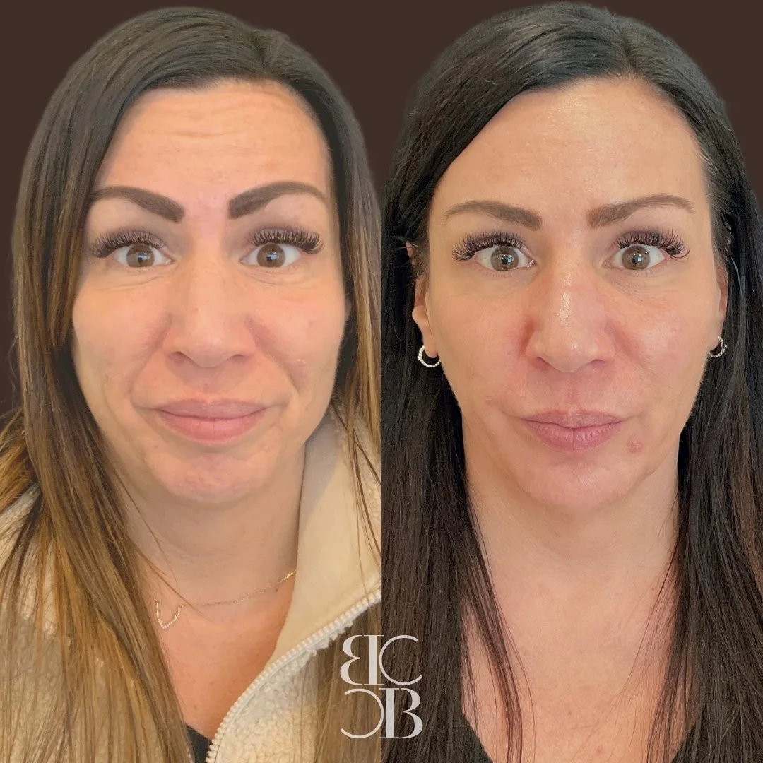 Botox before and after for forehead and crowsfeet.