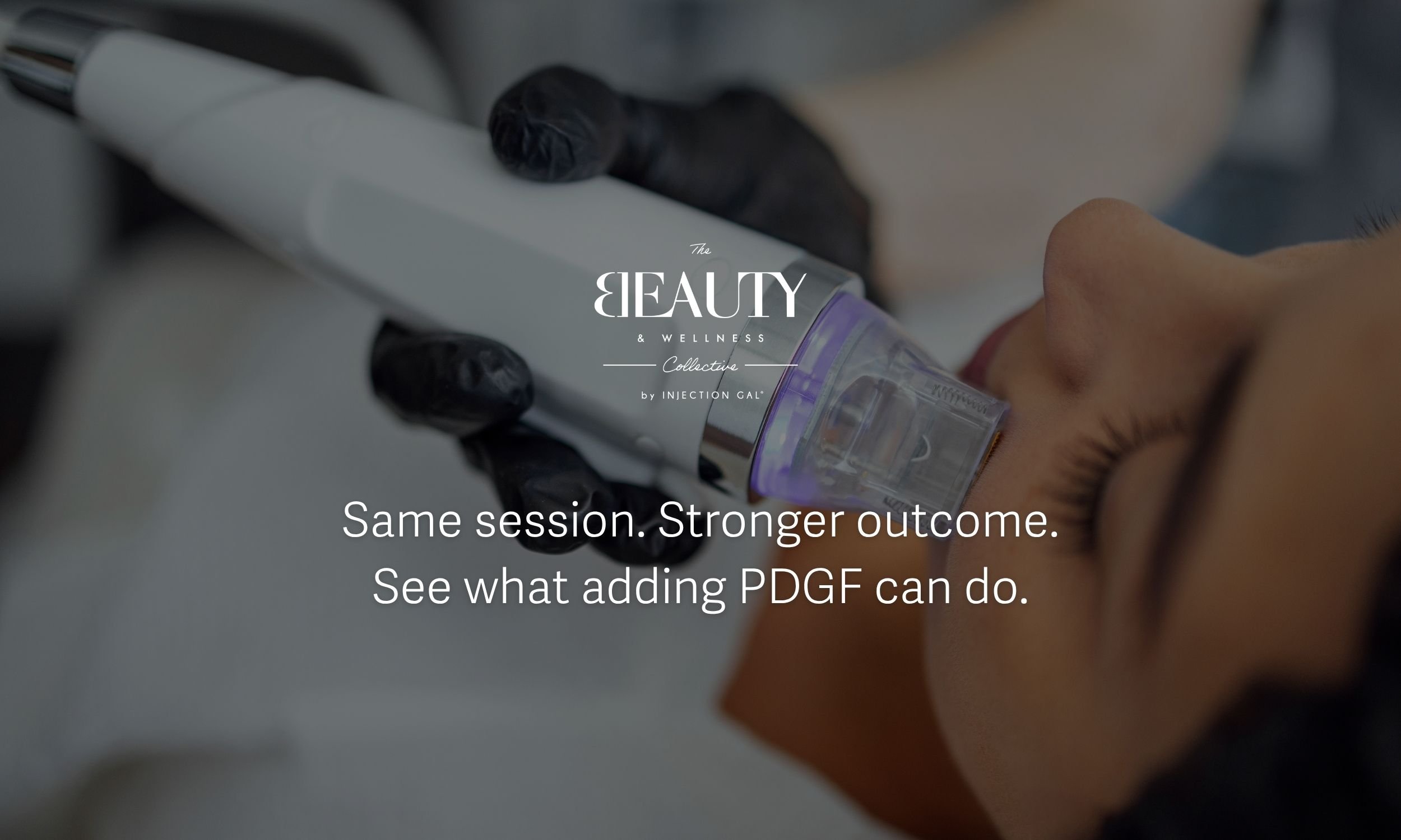 Microneedling With PDGF