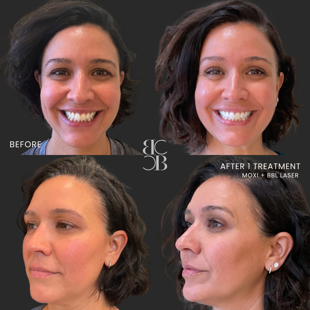 MOXI & BBL Laser before and after results