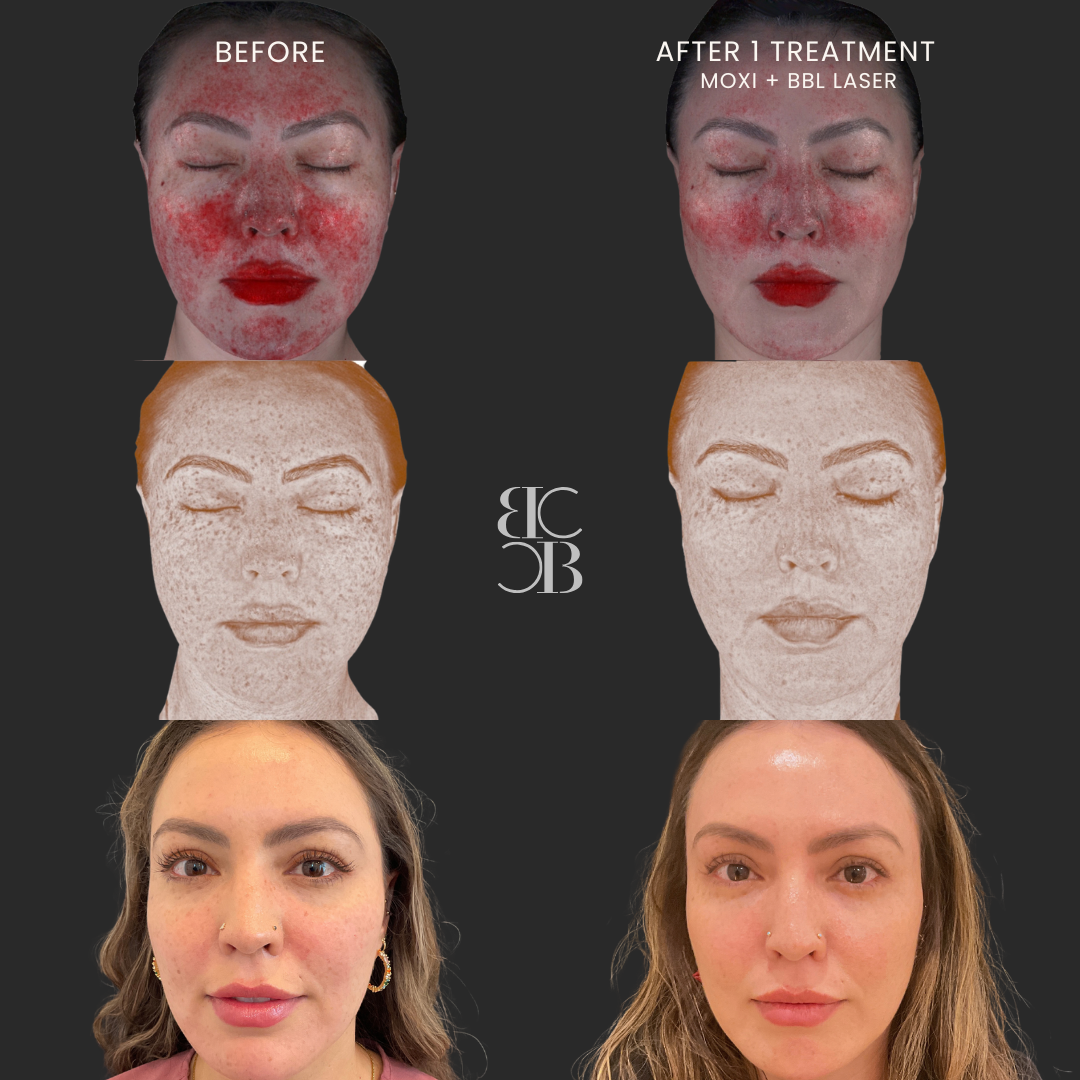 MOXI & BBL HEROic laser treatment results