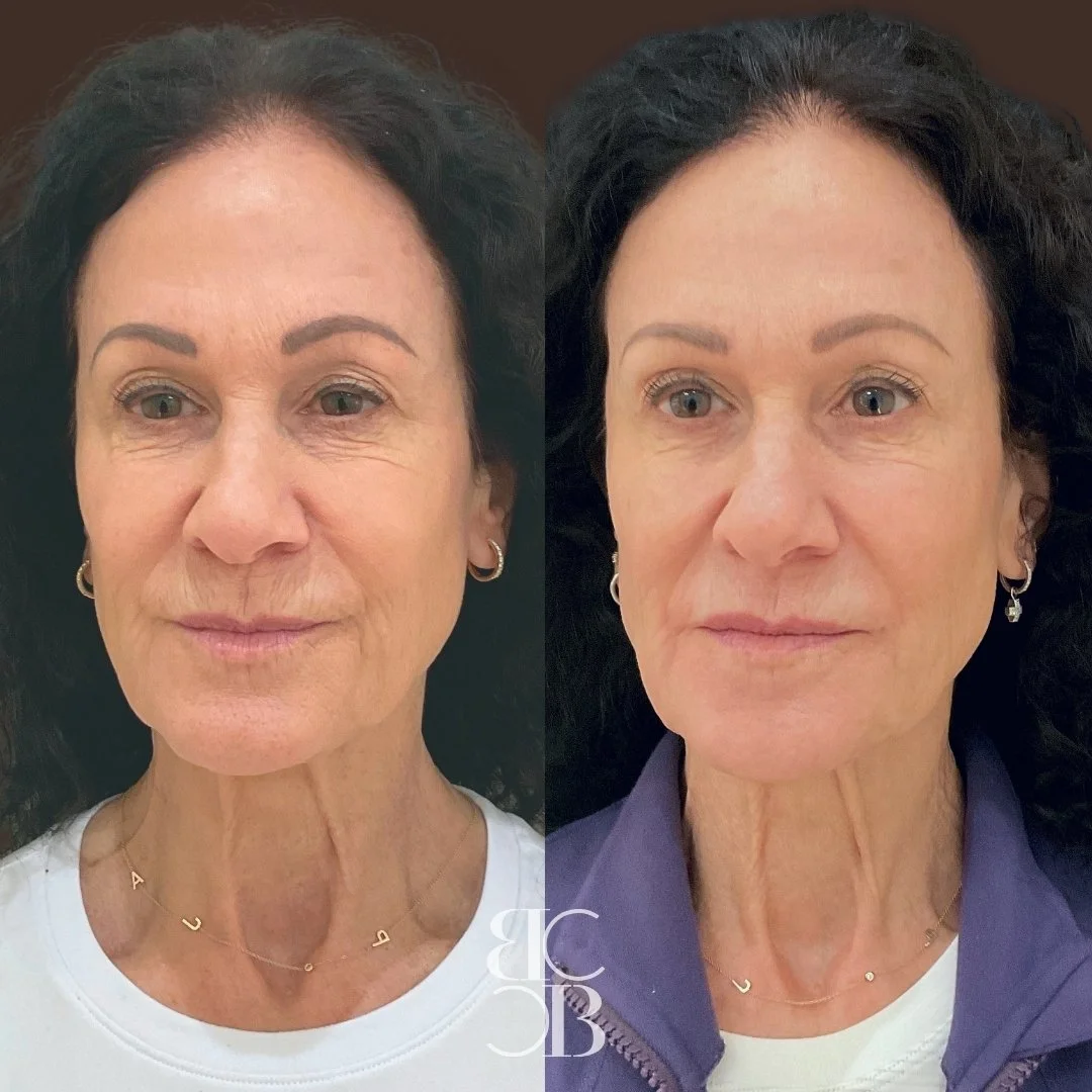 botox before and after for undereyes, neck, forehead, and chin.