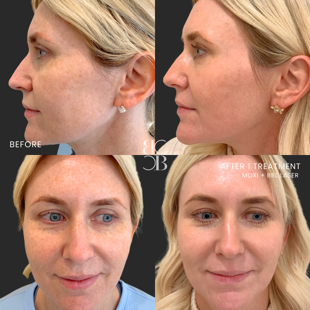 BBL Laser + MOXI Before & After