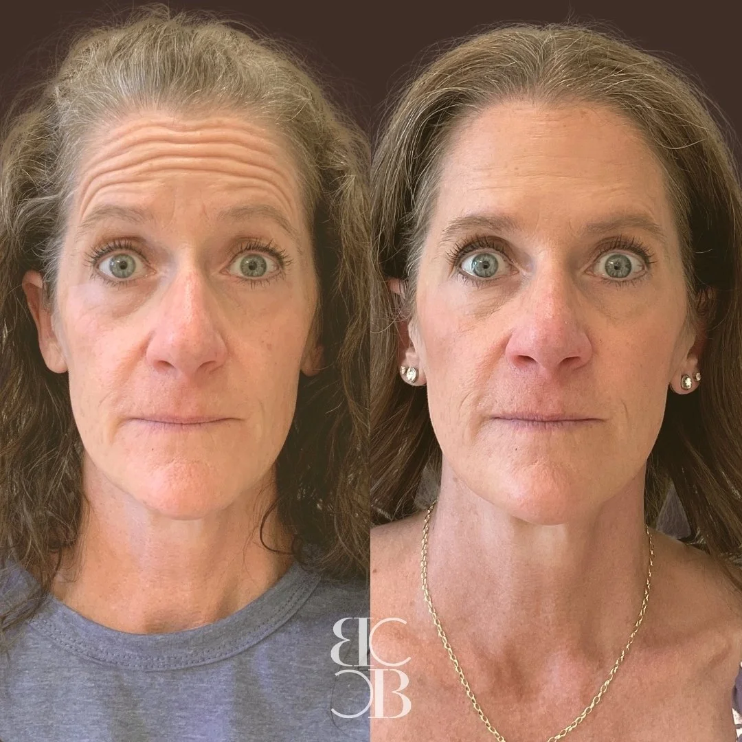 Before and After Botox Treatment in Reno for downward smile, crowsfeet, and forehead.