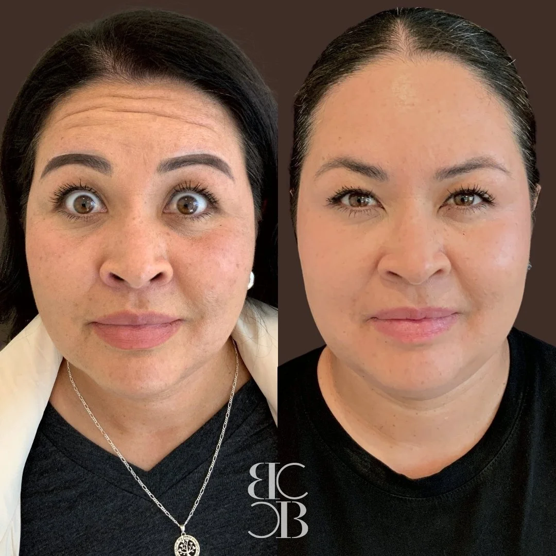 Frownlines, crowsfeet, and jaw slimming before and after