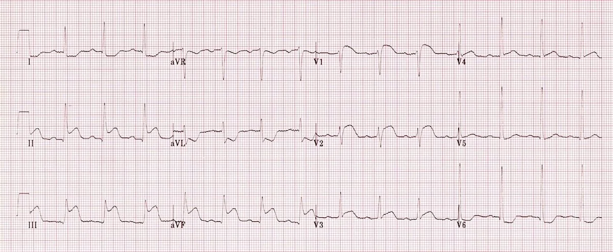 80 yo female presents with central chest pain. BP 80/40This ECG shows an inferior STEMI with right ventricular infarction.RV infarction is present in up to 40% of inferior STEMIs. It is important that in any patient with an inferior STEMI we look fo…