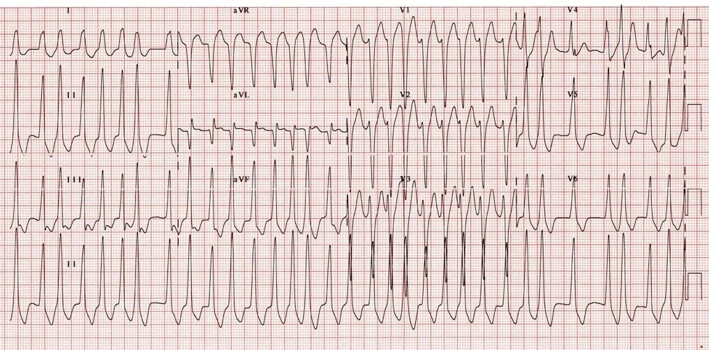 20 year old female presents with palpitations and presyncope. BP 75/50This ECG shows an example of AF with WPW. It is a spot diagnosis that can’t be missed as incorrect treatment can can lead the patient into VF/VT.The classic findings of AF with WP…