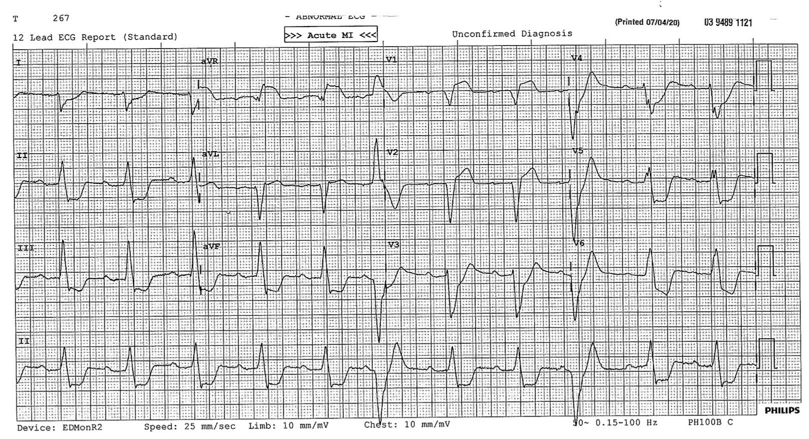 ECG of the week 16 April 2.jpg