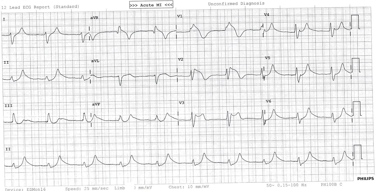 ECG of the week 23 March.jpg