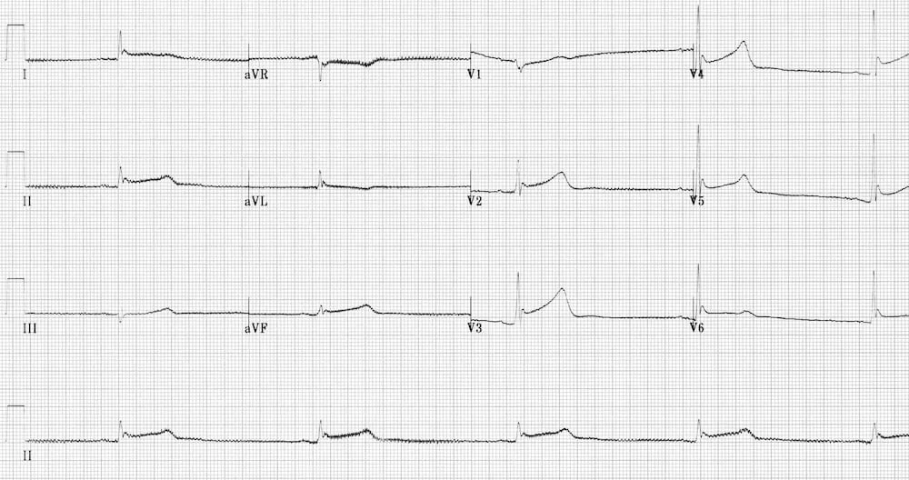 TOP-100-ECG-QUIZ-LITFL-010.jpg