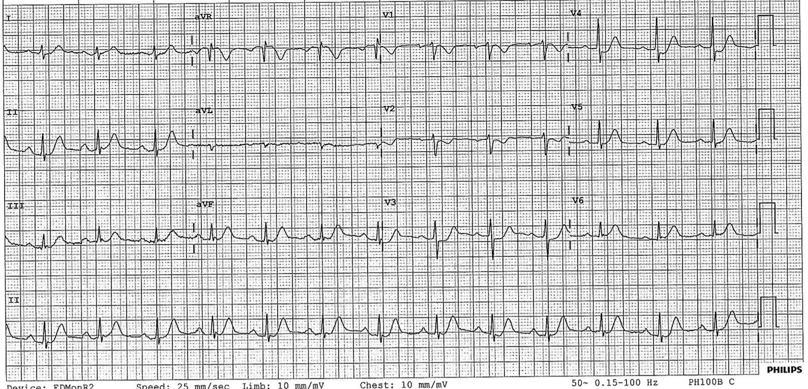Dino sent in this ECG from last week.The patient presented with 2.5 hours of chest pain. He looked unwell and was in distress. Vital signs within normal limits. He is 58 years old. Weight 75kgThis ECG shows ST depression in V2-V4. This ECG is sugges…