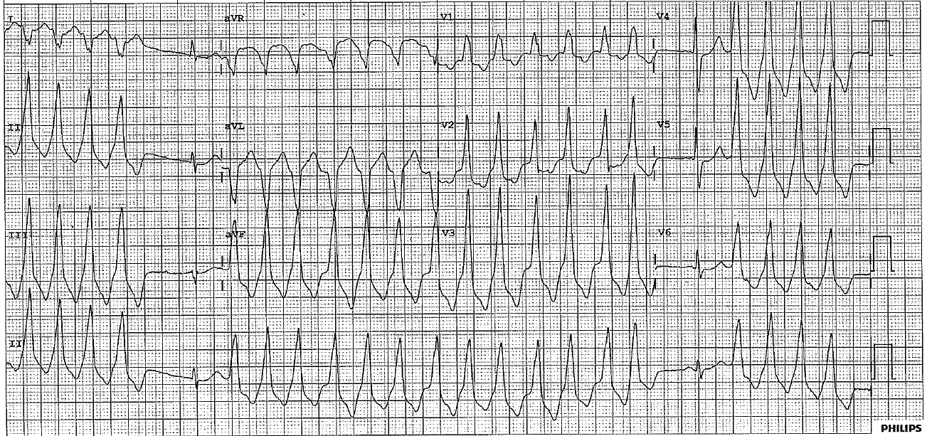 ECG of the week.PNG