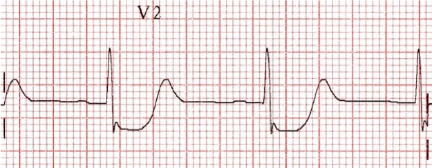 On the normal 12 lead, a posterior STEMI is suggested by horizontal ST depression in the anterior leads with an upright T wave.