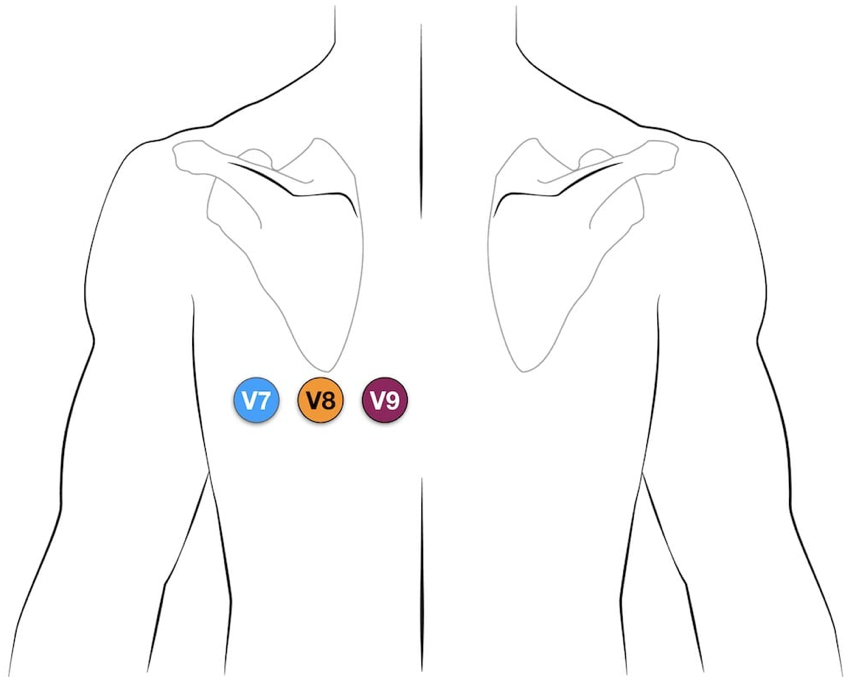 Posterior leads are easy. Take V4,V5,V6 off the patient and place on the back with V8 at the tip of the scapula
