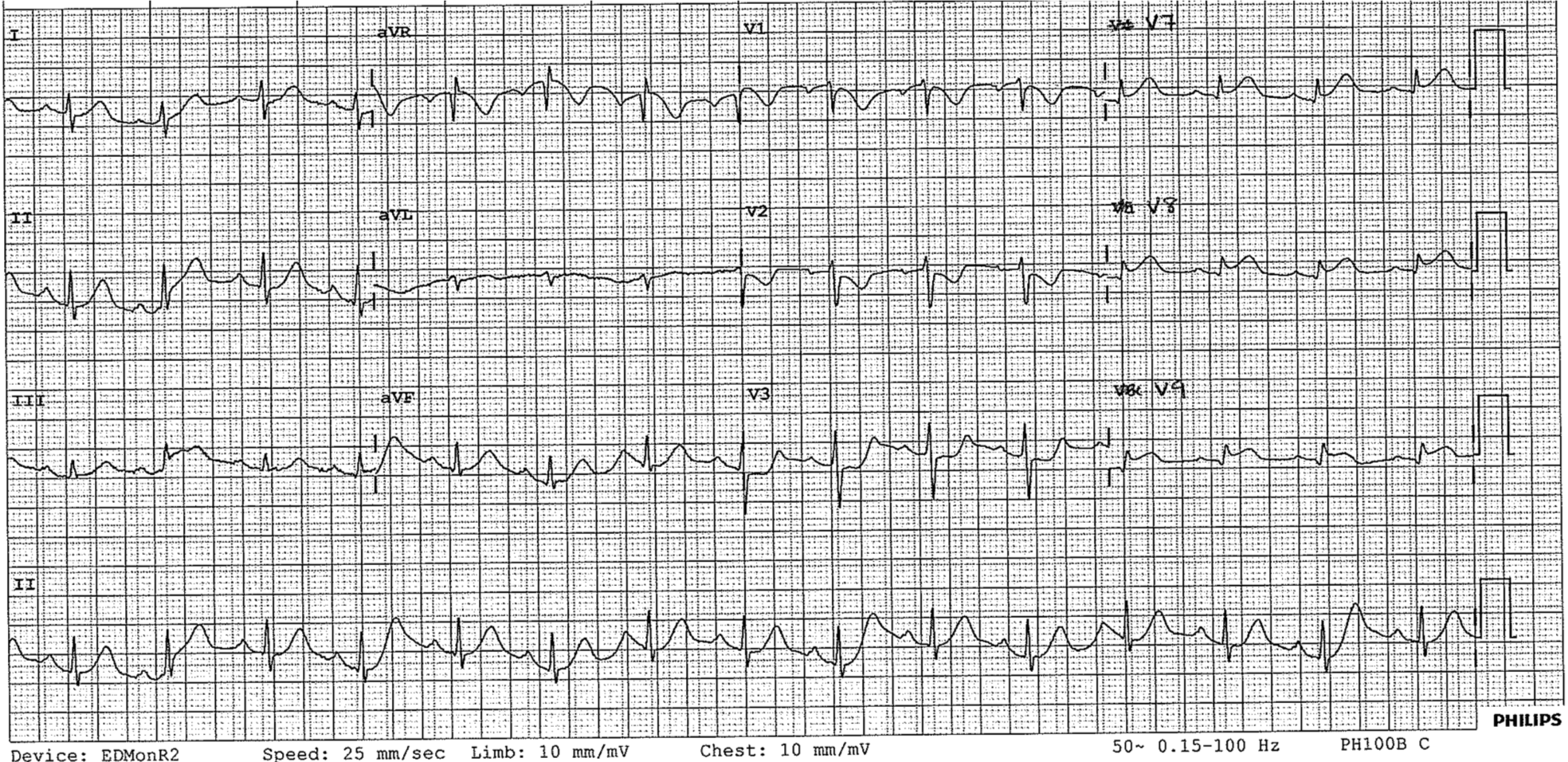 This is posterior ECG of this patient. Click to enlarge. The patient went to Cath lab and had a successful PCI.