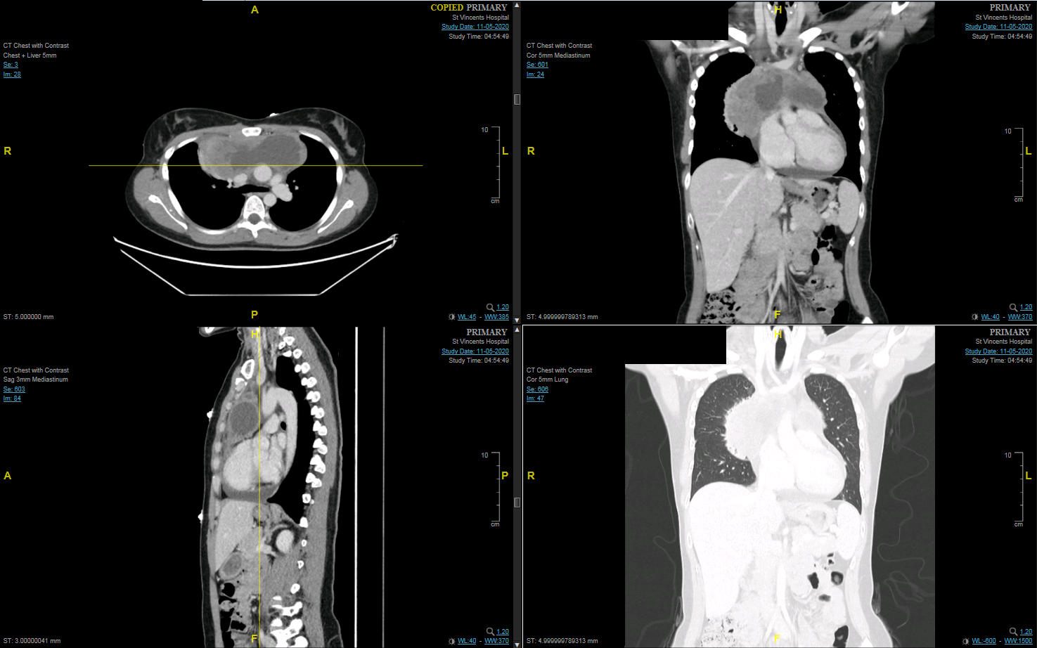 ct chest snapshot 2.png