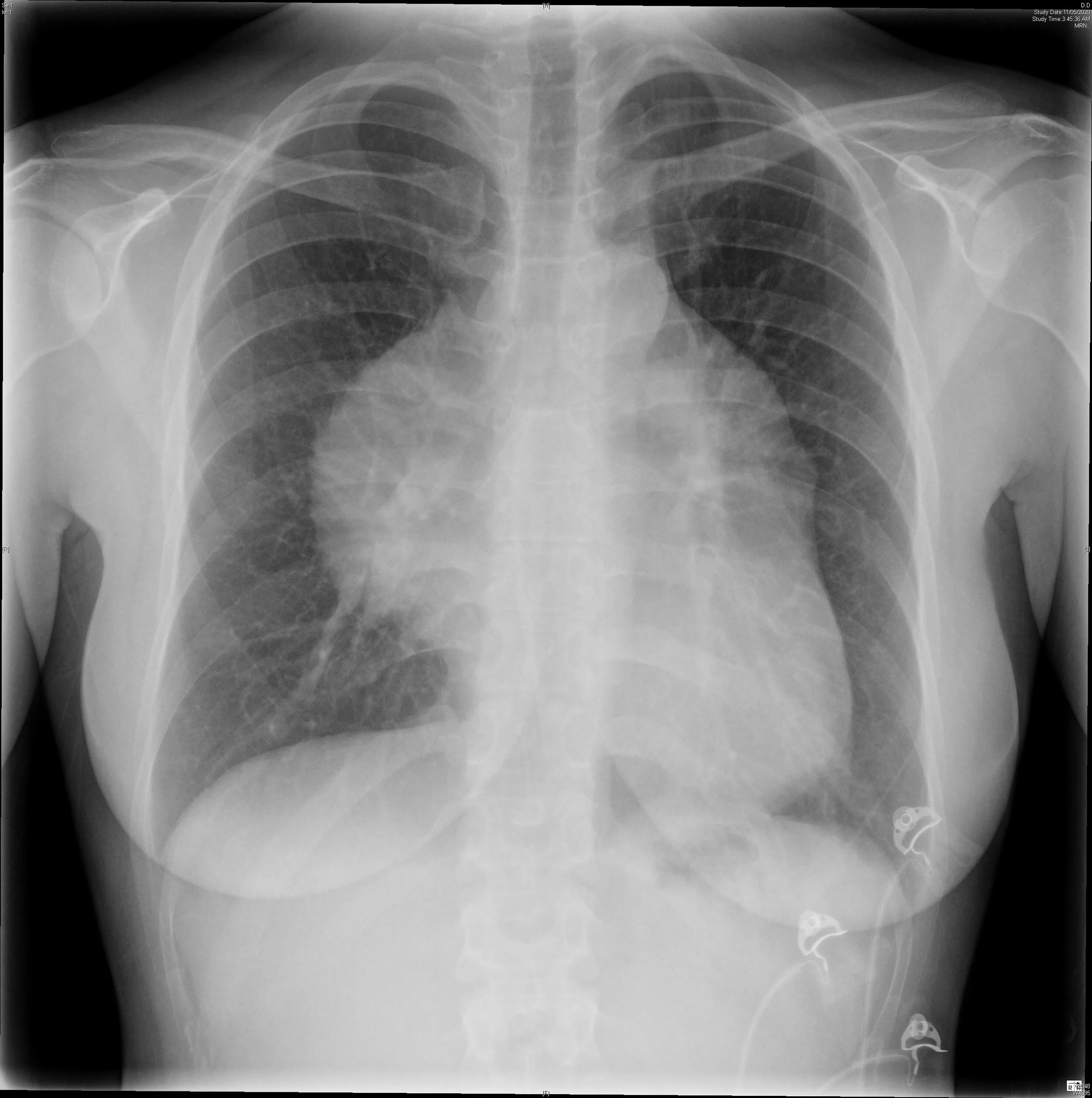 cxr mass.jpg