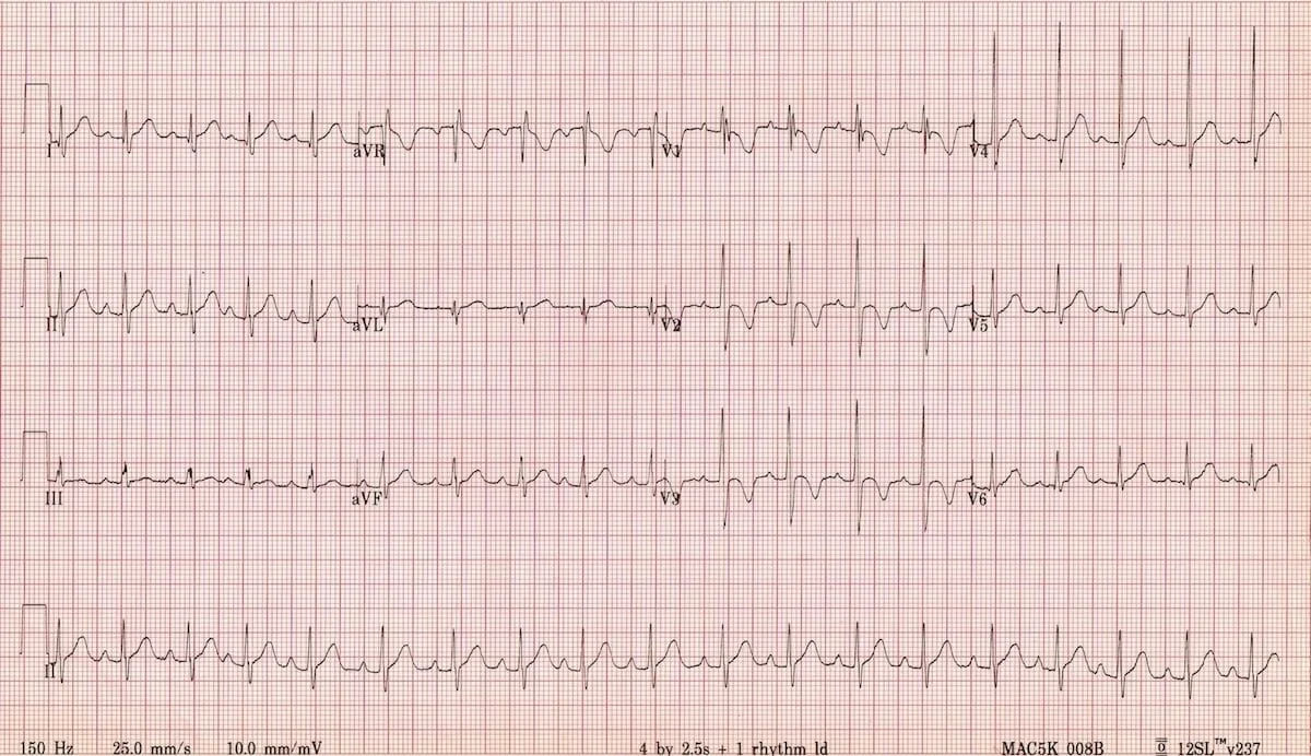 ECG-Incomplete-RBBB-Normal-Pediatric-2-year-old.jpg
