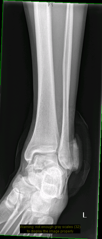 ankle 2.PNG