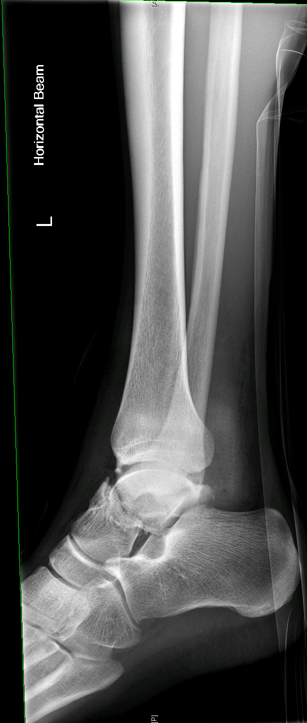 ankle 3.PNG