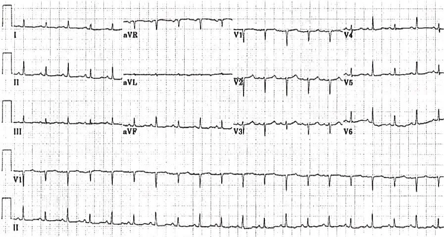 TOP-100-ECG-QUIZ-LITFL-011.jpg