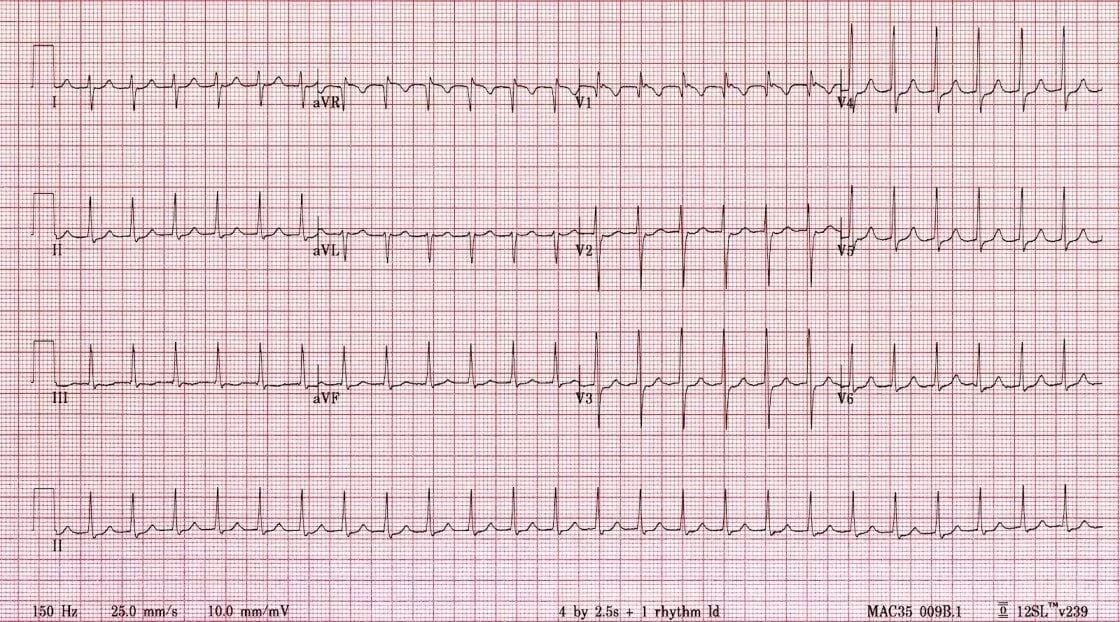 TOP-100-ECG-QUIZ-LITFL-016.jpg