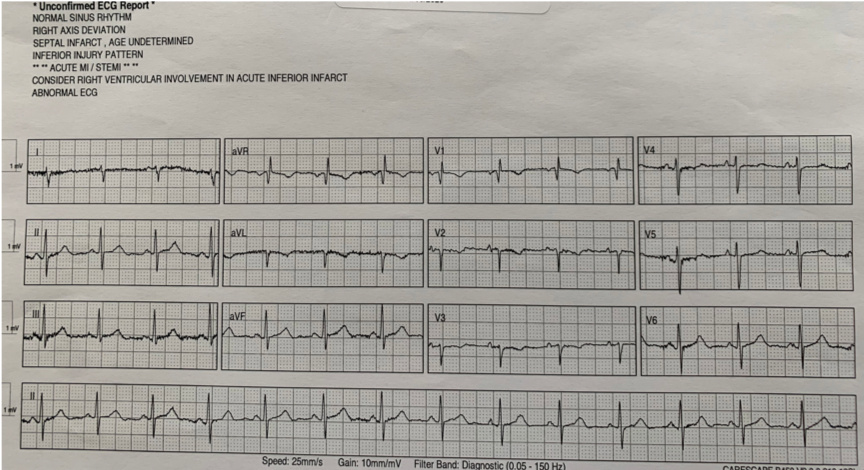 ECG from mark.png