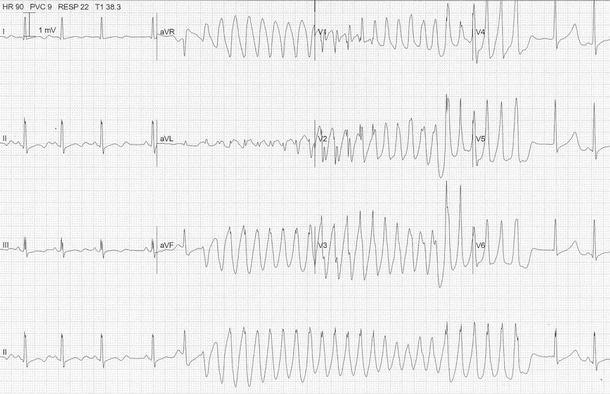 ECG-hypokalaemia-torsades-3.jpg