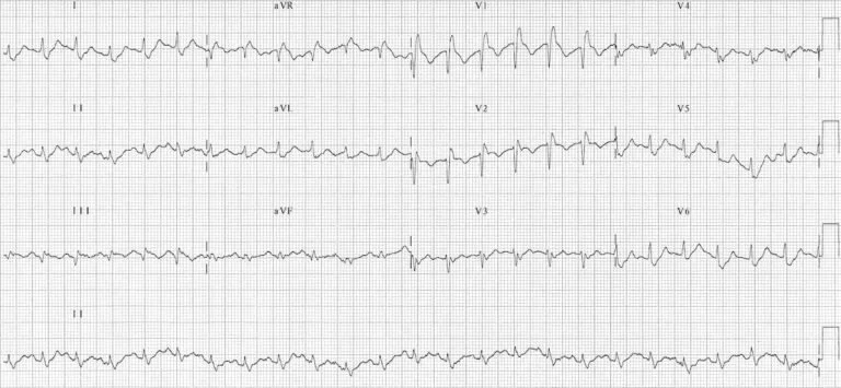 ECG-Massive-bilateral-pulmonary-embolus-768x355.jpg