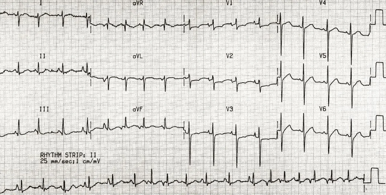 TOP-100-ECG-QUIZ-LITFL-033.jpg