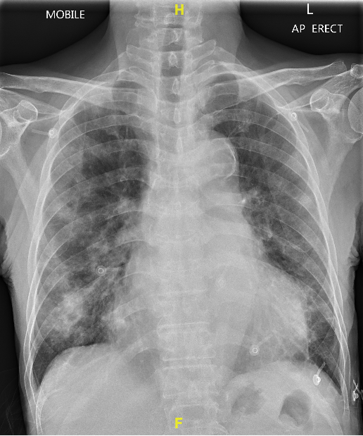 Image of the week cxr.PNG