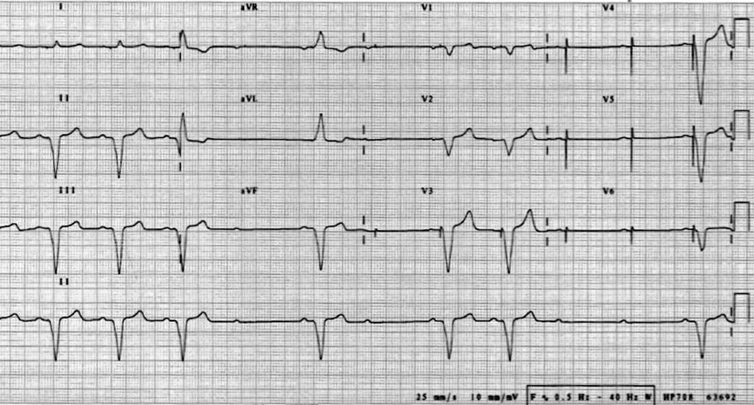 TOP-100-ECG-QUIZ-LITFL-035-2.jpg