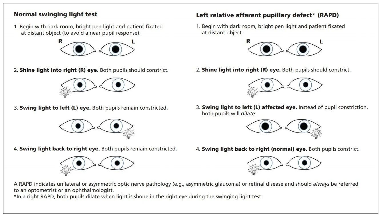 diagnosis-afferent-ophthalmology-rapd-defect-original.jpeg