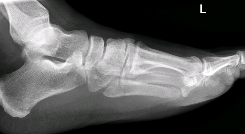 foot2.PNG