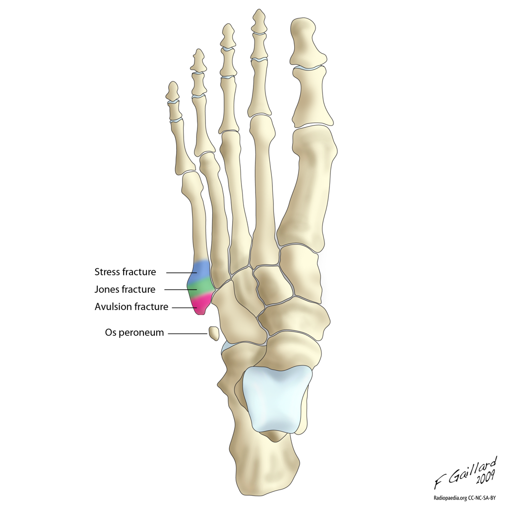 fractures-of-the-proximal-5th-metatarsal.png