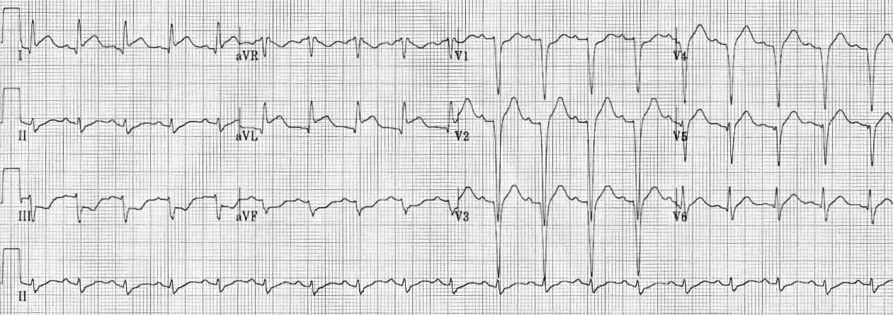 TOP-100-ECG-QUIZ-LITFL-036-2.jpg